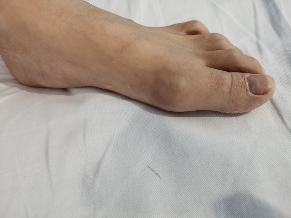 痛风患者足拇指关节怎么会常常出现疼痛?
